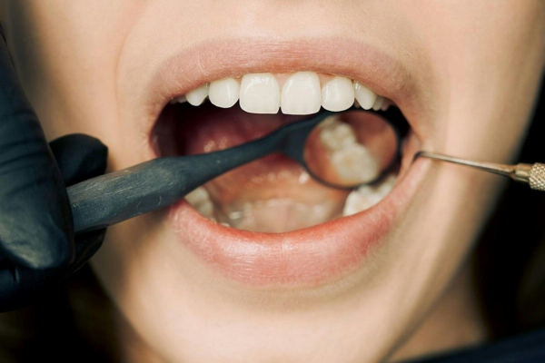 Patient receiving a comfortable and professional dental cleaning from a hygienist at Lutherville Dental serving Timonium and Lutherville