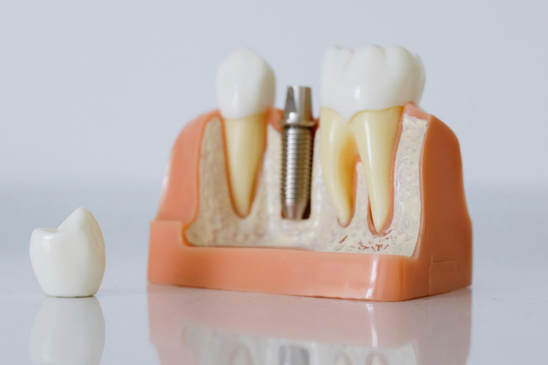 Patient receiving a custom dental crown restoration at Lutherville Dental in the Lutherville-Timonium area